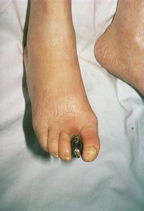 Gangrenous Toe In Diabetes Photograph by St Bartholomew Hospital ...