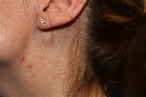 Swollen Lymph Nodes Ear