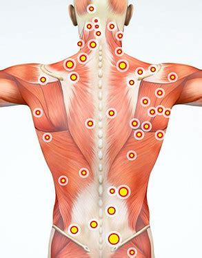 Myofascial Pain Syndrome - Conroe, TX: Jessen Mukalel MD