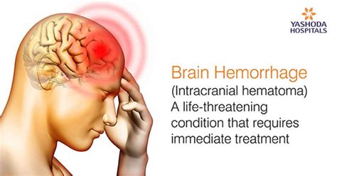 Brain Hemorrhage: Causes and Treatment