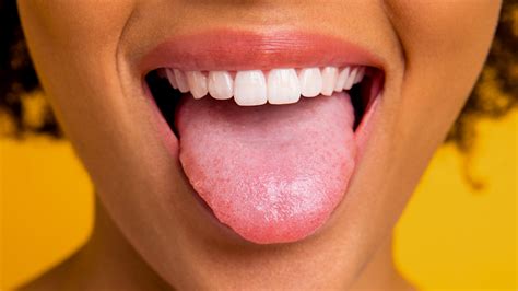 Can Geographic Tongue Affect Lips And Teeth | Lipstutorial.org