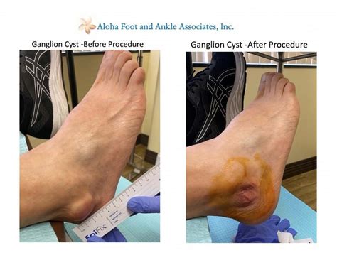 What Is A Ganglion On The Foot Store | emergencydentistry.com