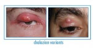 Chalazion Surgery New York City - Stye Treatment Manhattan - Dr. Brazzo