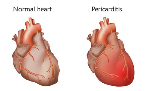 Pericarditis – Types, Symptoms, Causes, Treatment and Prevention