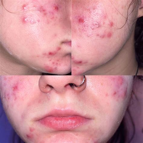 Acne Scars Before And After Accutane