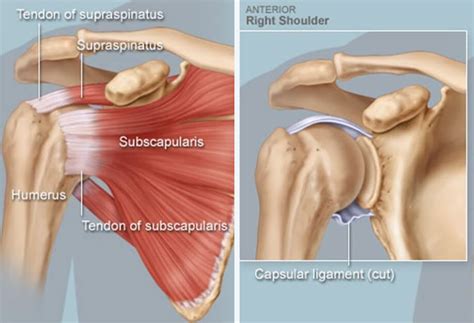 Shoulder Bursitis - Shoulder and Knee Surgery Perth