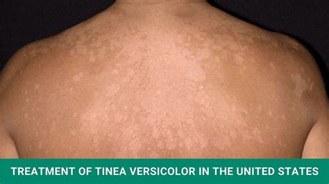 Treatment of Tinea Versicolor in the United States