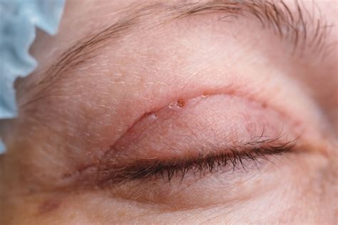 Eyelid Surgery: Preparation, Recovery, Long-Term Care