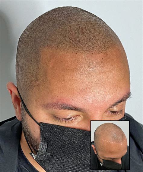 best scalp micropigmentation near me - Amazement Column Fonction