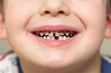 Why does my 4-year-old have so many cavities? | News | Dentagama