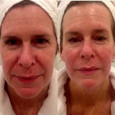 Before And After Of Thermage (10) | Thermage, Facelift