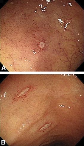 Isolated terminal ileal ulcerations in asymptomatic individuals: natural course and clinical ...