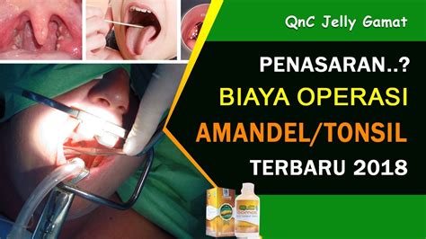 Penasaran..!! Biaya Operasi Amandel/Tonsil Pada Anak dan Dewasa Terbaru ...