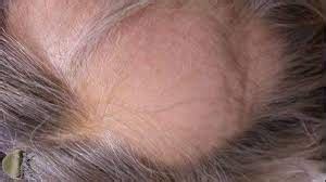 JAK Inhibitor Tofacitinib for Alopecia Areata - The London Skin And Hair Clinic