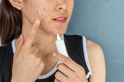 Is Zinc Good for Acne? We Asked Dermatologists