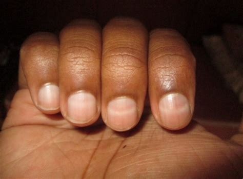 Beau's Lines On Nails: Causes, Symptoms, and Solutions