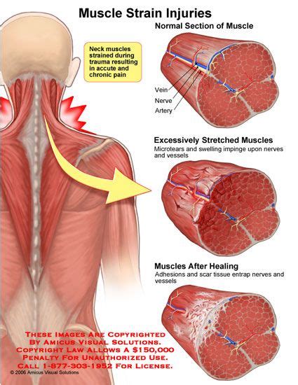 Strain Poster | Muscle strain, Scar tissue, Muscle