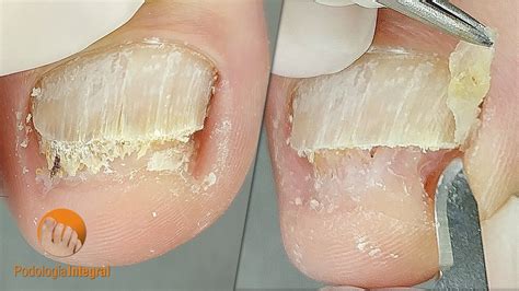 2 cases 1 video (XI) | #1 Onychomycosis | #2 Onychogryphosis ...