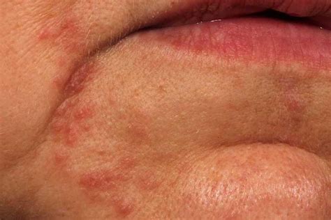 What Causes A Red Rash Around Your Lips | Allergy Trigger