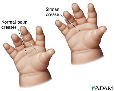 Abnormal Palmar crease in newborn- Please note that we no longer use the term Simian | Peds Nsg ...