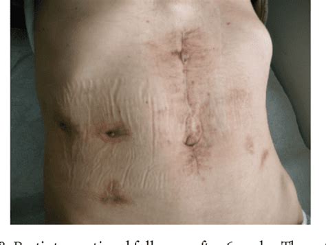 Figure 1 from Endoscopic Treatment of a Gastrocutaneous Fistula Using ...