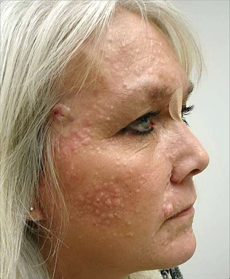 Numerous Facial Lesions in a 47-Year-Old Woman—Quiz Case | Dermatology | JAMA Dermatology | The ...