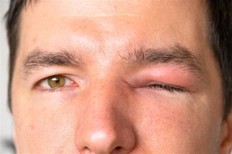 Premium Photo | A red swollen eyelid on a man's face in closeup is an allergy to an insect bite ...