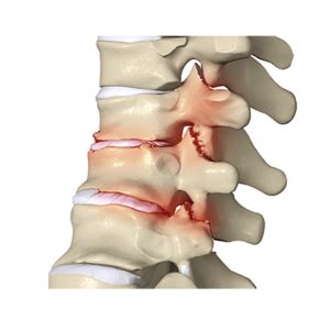 Arthritis of the Spine Treatment | Spine Laser Institutes