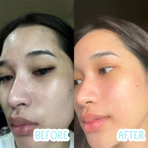 Slap water, one envelope, change life, clear face without acne | Gallery posted by Km Kaimook ...