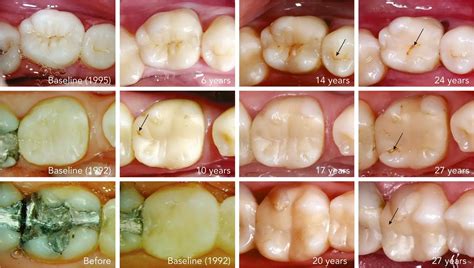 Clinical performance of direct resin composite restorations