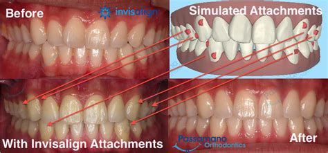 How to Remove Invisalign Attachments: Quick & Safe Tips - favourite ...