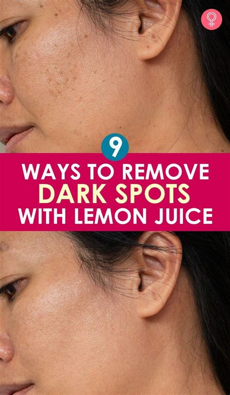 How To Use Lemon Juice For Dark Spots On Face – 10 Natural Ways | Dark spots on face, Dark spots ...