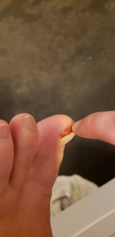 What is the most gentle way to remove a dead toenail? | RallyPoint