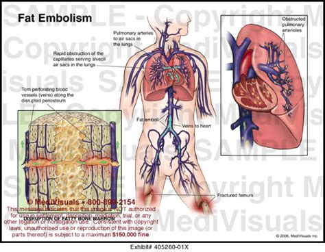 Fat Embolism Medical Illustration Medivisuals