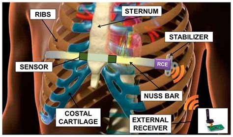 Sensors | Free Full-Text | A Sensorized Nuss Bar for Patient-Specific Treatment of Pectus ...