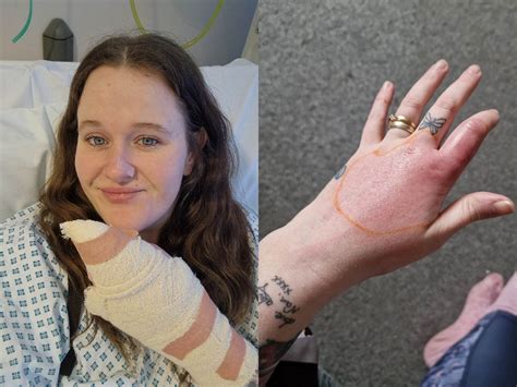 ‘Spot’ on woman’s finger turned out to be false widow spider bite
