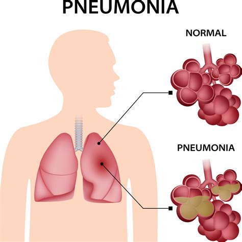 Pneumonia | Private Pneumonia Treatment | Respiratory London