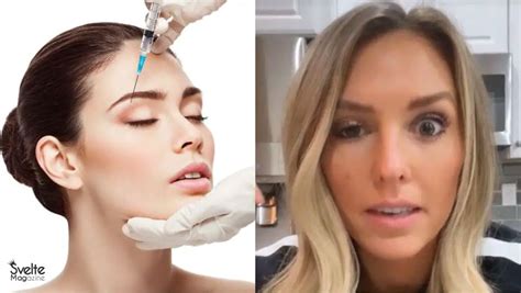 Botox Under Eyes: What You Didn’t Know About This Procedure