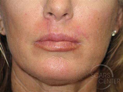 Basal Cell Carcinoma On Upper Lip Pictures | Sitelip.org