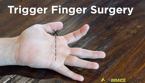 There Are Two Surgical Options to Treat Trigger Finger Pain