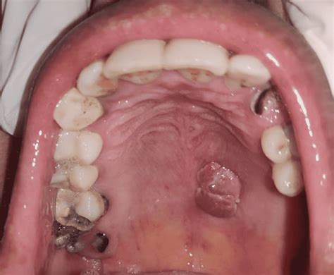 Squamous Papilloma on the Hard Palate: A Rare Clinical Entity | Cureus