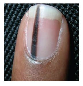 Diagnosis and Treatment of Pigmented Nail Lesions