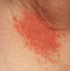 Armpit Rash, Causes, Pictures, Red, Itchy, Painful, Both Armpits, in Male, Child, Cream, Home ...