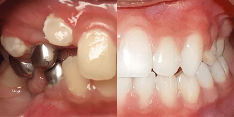 Before and After | Unique Orthodontics