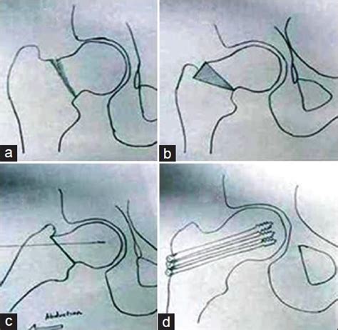 A line diagram showing (a) Stress fracture of the neck femur with varus... | Download Scientific ...