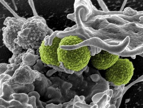 Toxic Shock Syndrome: How Bacterial Toxins Can Turn Our Immune System ...