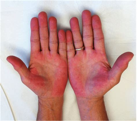 Palmar Erythema: What It Is, Causes, Pictures, Treatment