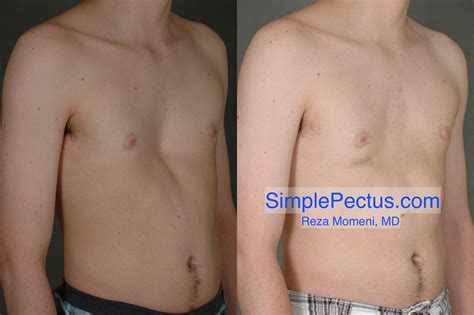 Pectus Carinatum Brace Before And After