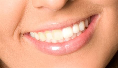 Understanding Teeth Stains: Causes and Tips for Prevention