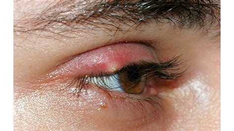 Oral Antibiotics For Eye Infection | Renew Physical Therapy